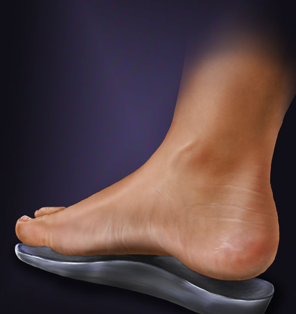 custom orthotics